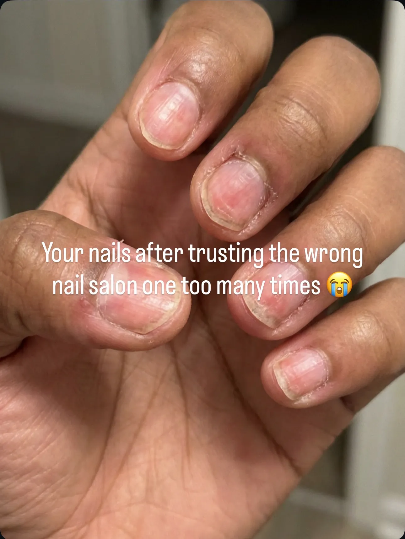 Before — damaged nails from salon