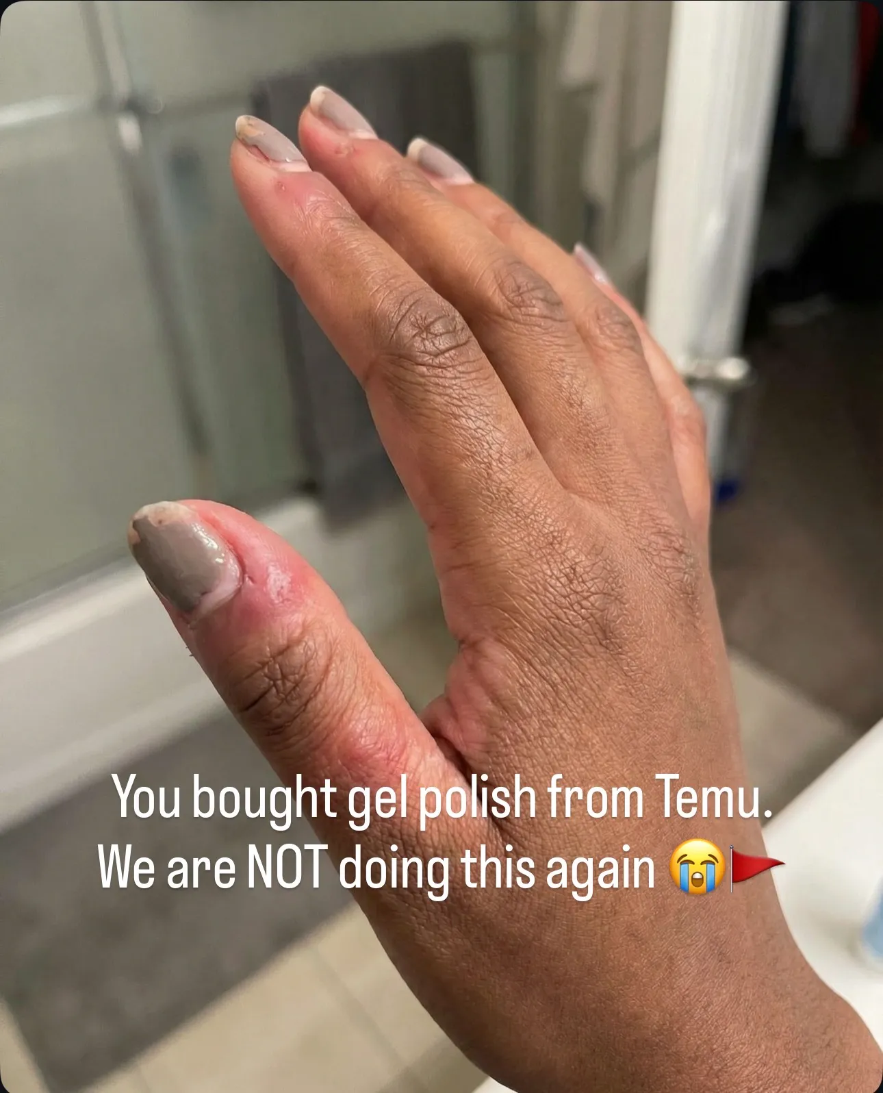 Before — damaged nails from salon